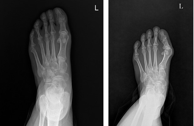 정상 발(왼쪽)과 무지외반증 발을 비교한 엑스레이 영상. 사진=바른세상병원