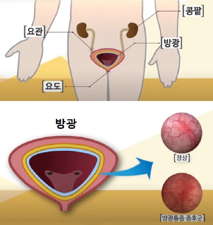 인체 내 방광의 위치와 정상/통증증후군 비교