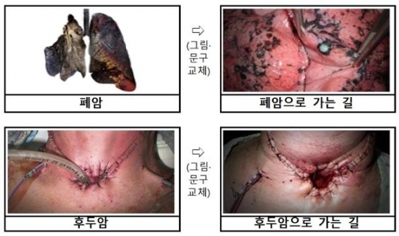 지난해 12월 23일부터 새로 적용되고 있는 담뱃갑 경고 그림과 문구. 왼쪽이 기존 그림·문구이고 오른쪽이 더 경각심을 높인 그림·문구이다. 사진=보건