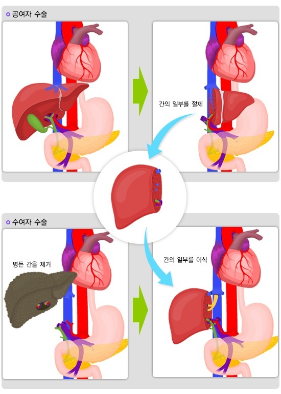 간암 치료법의 하나인 생체 간이식 모식도. 출처=국가건강정보포털