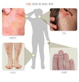 [건강e+ 삶의 질] 가렵고 붉은 반점 ‘건선’, 유전 요인 크지만 ‘전염성 0’